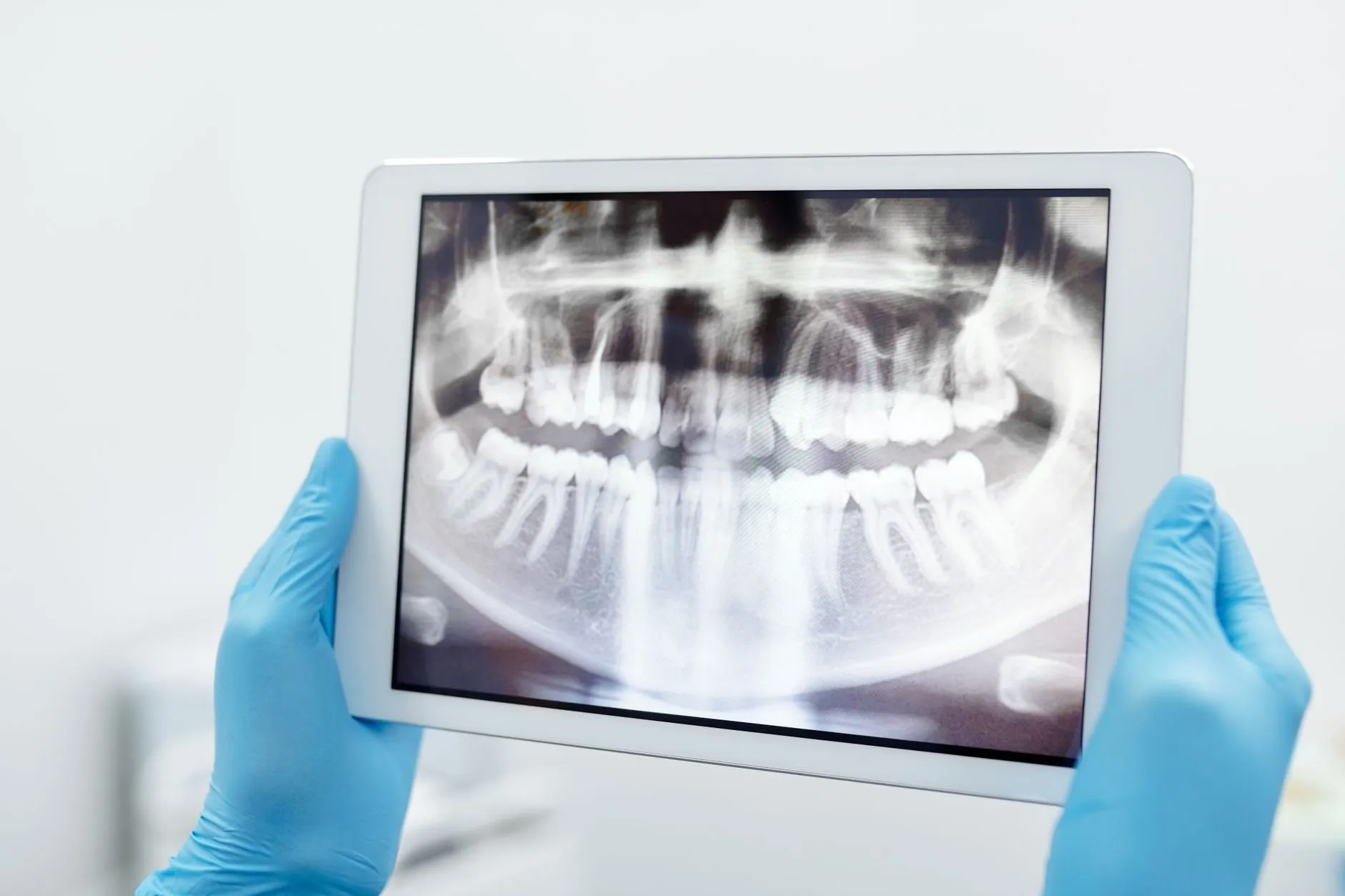 A panoramic X-ray on a tablet held in gloved hands